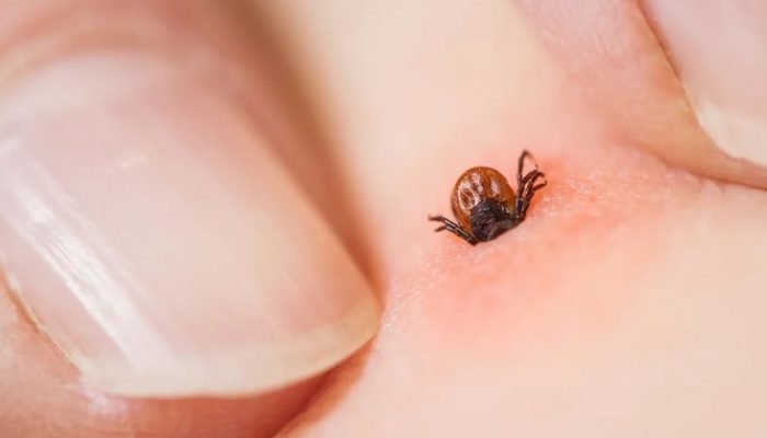 Why you should never remove a tick with your fingers, according to a nurse